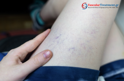 Σκληροθεραπεία