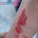 Αγγειίτιδα κάτω άκρων – έγκαιρη διάγνωση