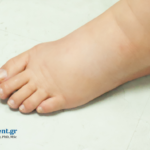 Οίδημα κάτω άκρων – διάγνωση από παθολόγο