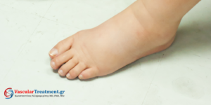 Οίδημα κάτω άκρων – διάγνωση από παθολόγο