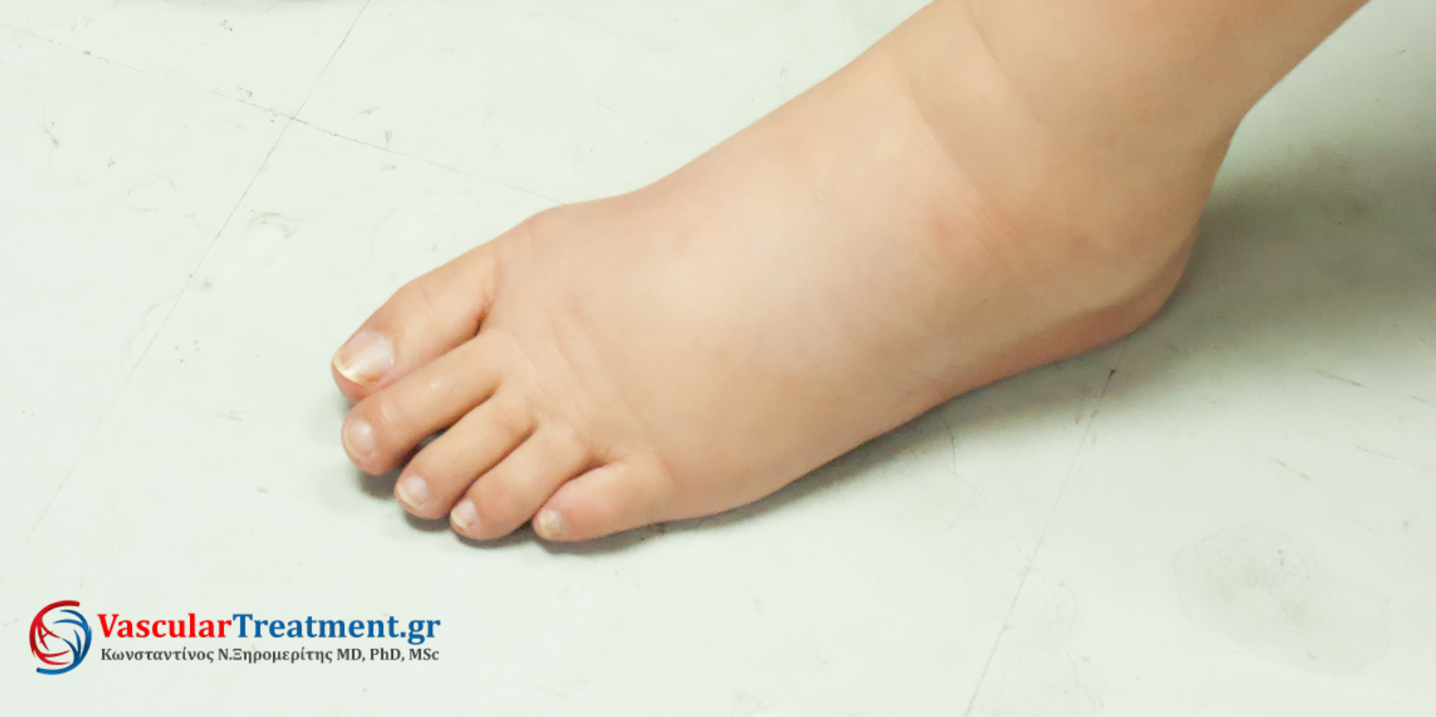 Οίδημα κάτω άκρων – διάγνωση από παθολόγο