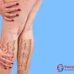 Σύγχρονη θεραπεία κιρσών με ενδοφλεβικό laser και RFA