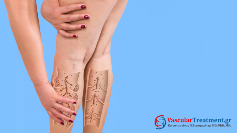 Σύγχρονη θεραπεία κιρσών με ενδοφλεβικό laser και RFA