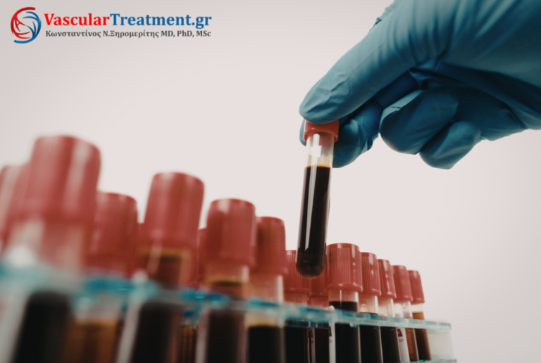 Σύγχρονες ενδοφλεβικές τεχνικές αντιμετώπισης κιρσών με laser και RFA