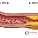 Βουλωμένες Αρτηρίες