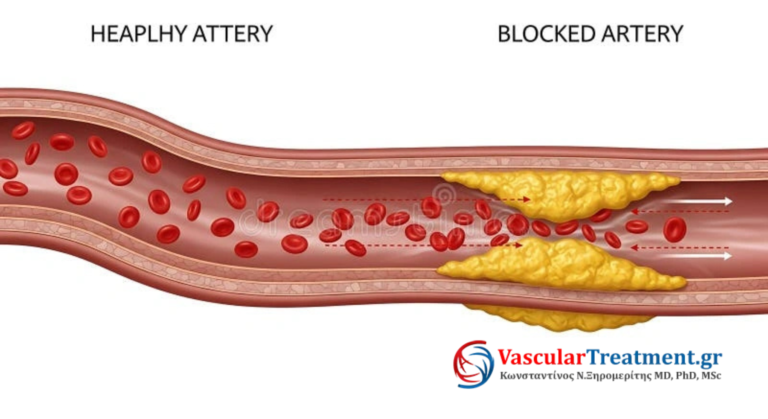 Βουλωμένες Αρτηρίες