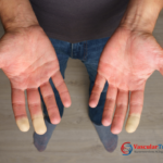 σύνδρομο Raynaud