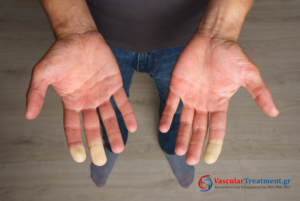 σύνδρομο Raynaud