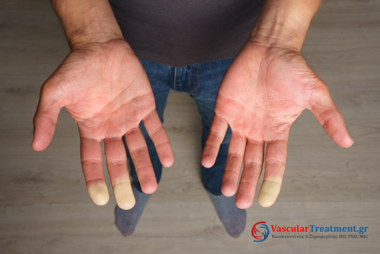 σύνδρομο Raynaud