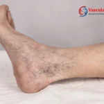 Πόδι με ευρυαγγείες στον αστράγαλο πριν από σκληροθεραπεία ευρυαγγειών